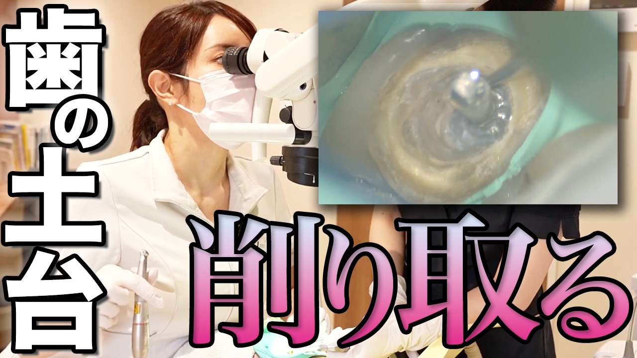 Full Coverage of a Root Canal Treatment for a Patient with a Tooth