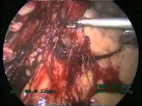 Laparoscopic Left Colectomy, Step By Step دكتور احمد شكري  .استئصال سرطان القولون بالمنظار