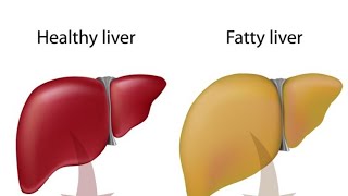 تخلص من دهون الكبد في خطوتين ✌️✌️??fattyliver