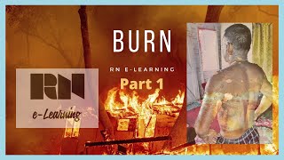 Burn | Part 1