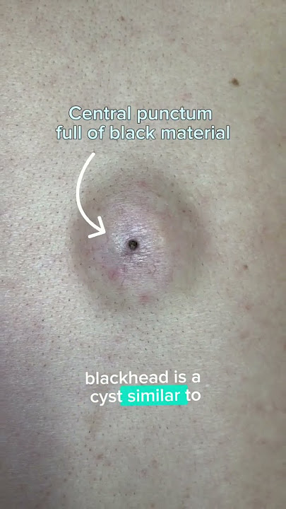 LARGE BLACK HEAD (BACK MASS REMOVAL) - DR. TANVEER JANJUA- NEW JERSEY