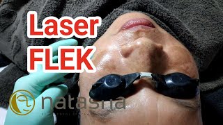 Laser Flek Natasha Skincare | on the spot NSCC Sidoarjo