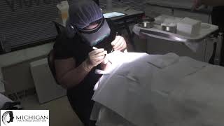 NeoGraft Hair Transplant With Dr. Berkowitz