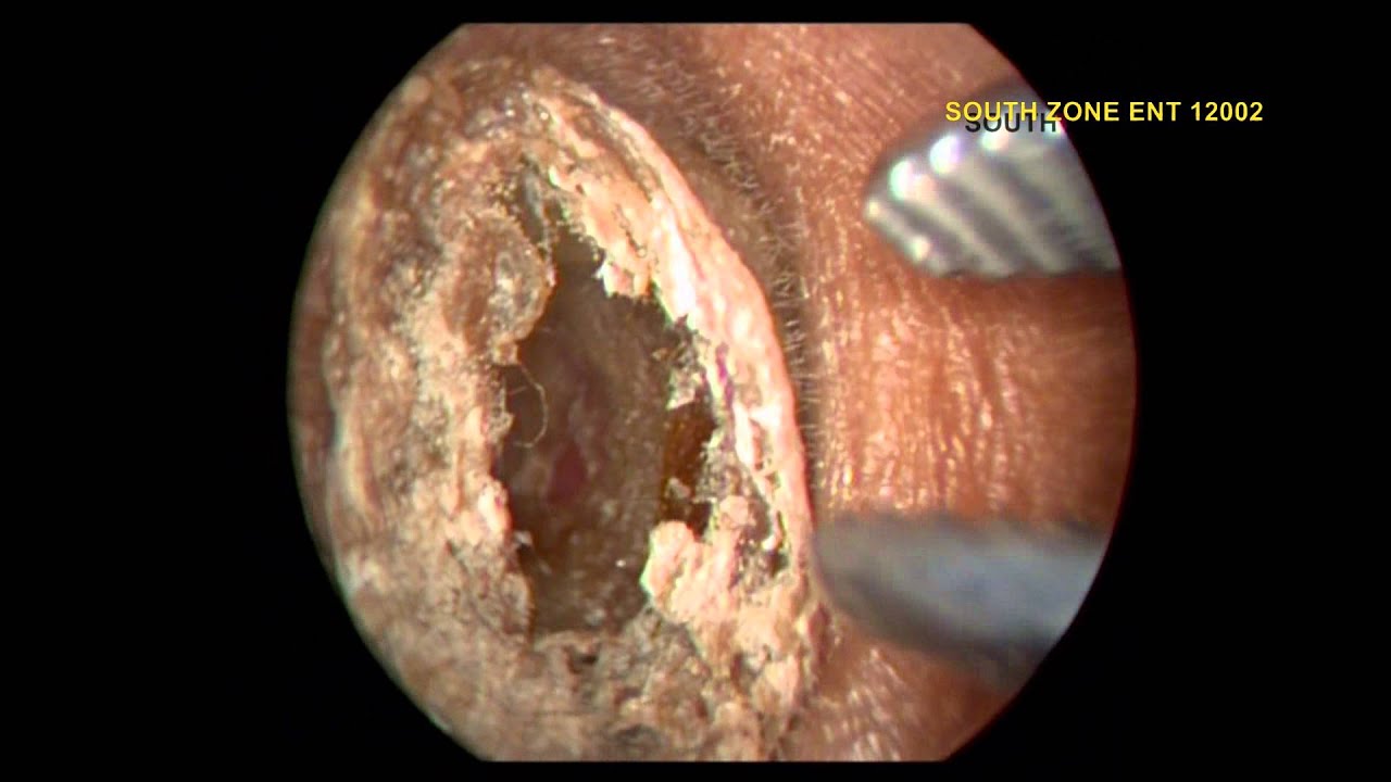 THE MOULDED EAR IMPACTED WAX - YouTube