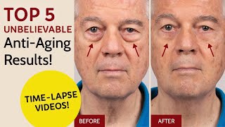 Top 5 Unbelievable Anti-Aging Results! For Eye Bags, Crow's Feet, Fine Lines and Forehead Wrinkles by Derm Dude 81 views 2 years ago 2 minutes, 47 seconds