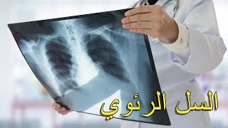 6- السل الرئوي (الدرن) : الأعراض وكيفية الوقاية وطرق العلاج