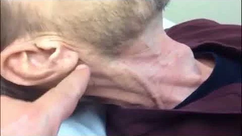 Jugular Venous Distention on Physical Examination