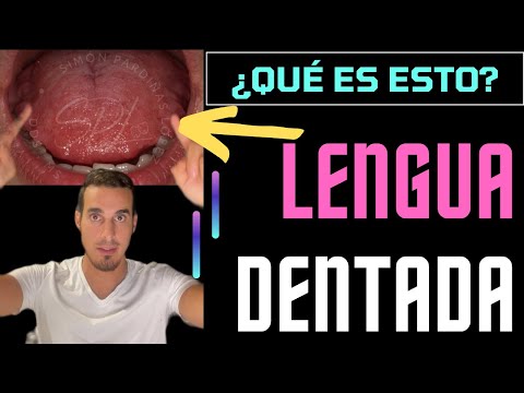 Video: ¿Se quita la lengua festoneada?