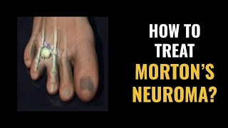 Morton's NEUROMA Treatment Options (Home and Doctor Treatments)