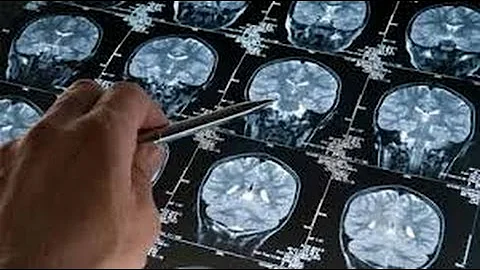 Preventing Brain Loss with B Vitamins?