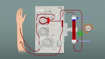 Let’s learn (Surdial X Training Series) - How does the Clean Treatment Start (CTS) work?