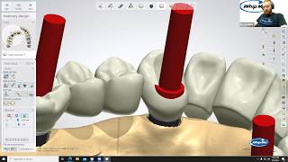 Digital Dentistry Training Series: Toronto Bridge Design