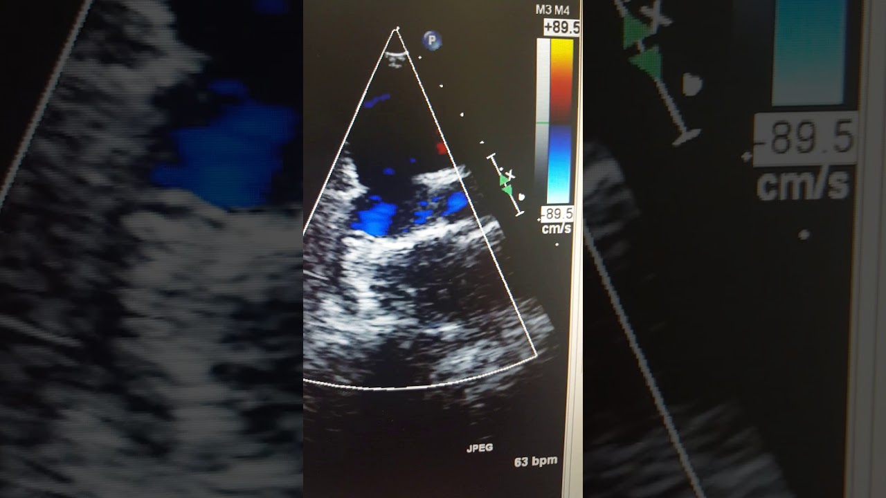 Case# 36 echocardiography bidirectional Glenn shunt - YouTube