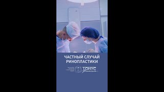 Частный случай ринопластики