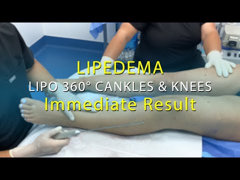 Lipedema | Lipo 360° Legs | Leg Liposuction Surgery Results | Cankles & Knees | Expert Dr. Thomas Su