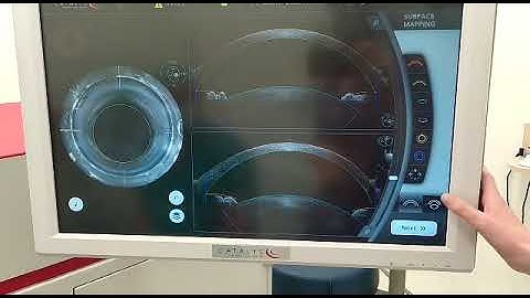 Adjusting the axis in anterior segment OCT - laser cataract, arcuate incisions1