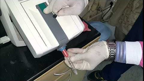 Implant Level Impression with Open Tray Using Pick Up Impression Coping. Case By: Dr. Akash Akinwar