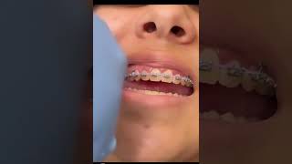 Ever wonder how braces are removed? Let us take you behind the scenes! Hello gorgeous smile 😁