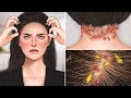 Asmr removal acne and head lice from the nape at hairline  seborheic dermatitis treatment
