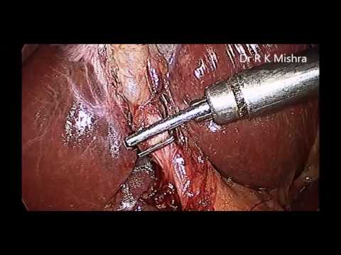 Laparoscopic Surgery for Gall Stone Disease