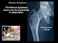Fibrous Dysplasia - Everything You Need To Know - Dr. Nabil Ebraheim
