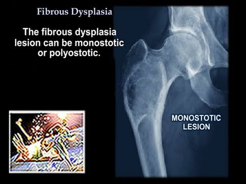 Fibrous Dysplasia - Everything You Need To Know - Dr. Nabil Ebraheim