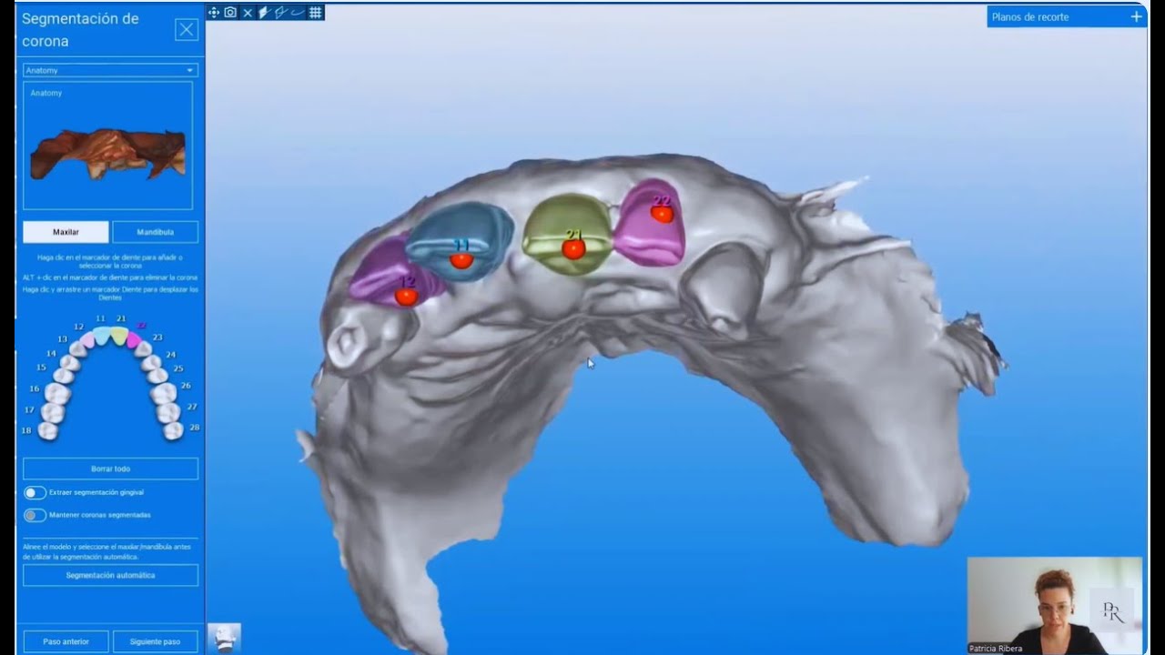 Los tres pasos clave para segmentar coronas en RealGUIDE.