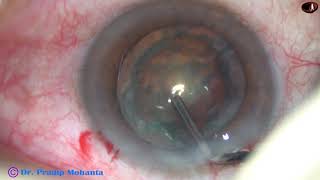 Management of a soft cataract - Dr Pradip Mohanta, 2nd Sept, 2018 screenshot 2