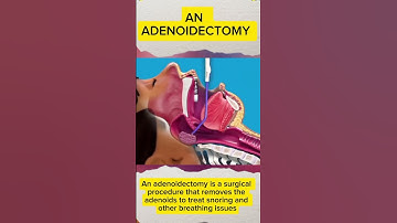 "Adenoidectomy Explained: How Removing Adenoids Can Help Stop Snoring and Improve Breathing"
