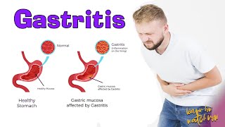 Gastritis | Causes | Signs and symptoms | Foods to avoid gastritis