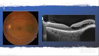 Capítulo 5 Tumores Intraoculares