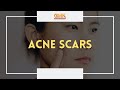 Acne Scars (PART 3) | Usapang Pangkalusugan