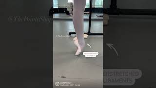 OVERSTRETCHED ligaments en pointe Resimi
