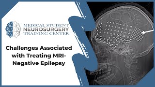Challenges Associated with Treating MRI-Negative Epilepsy