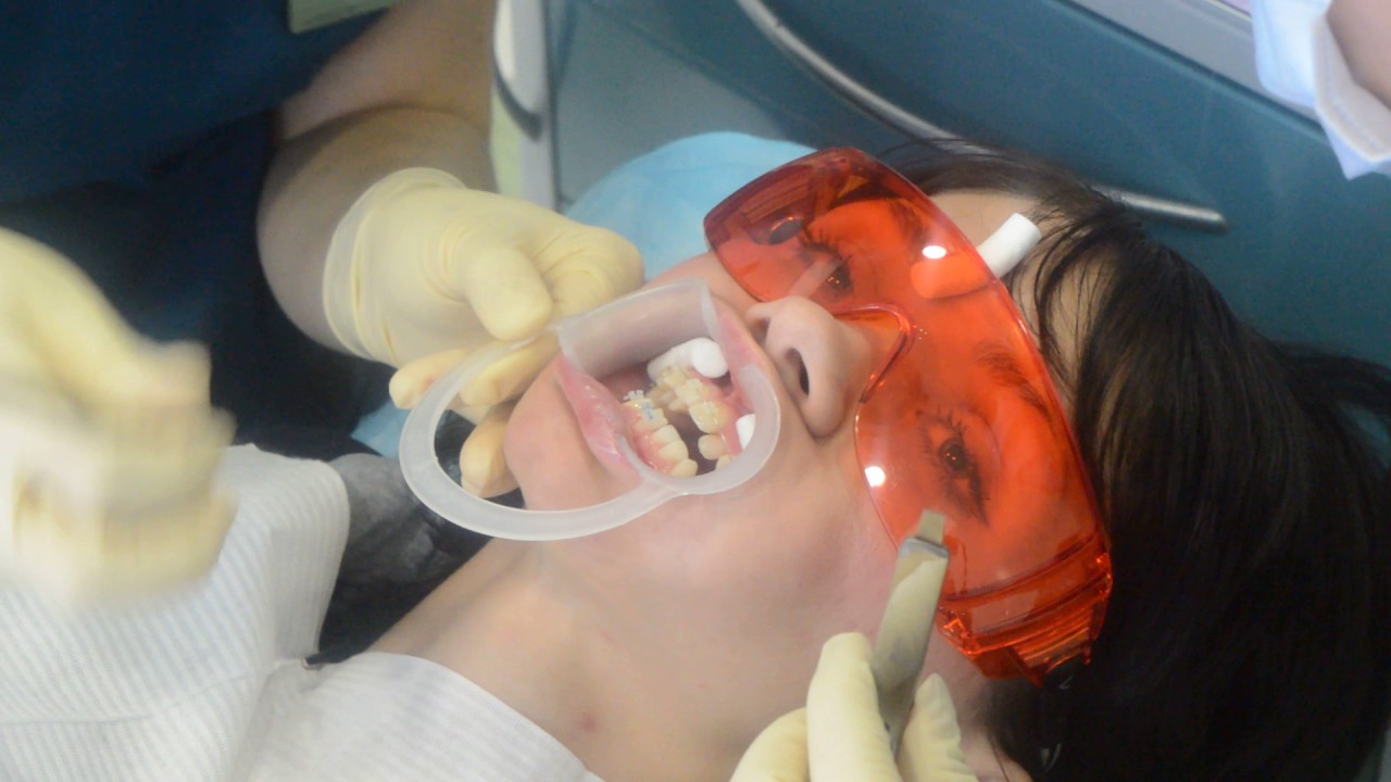 Фиксация брекетов Clarity Advanced с технологией защиты эмали Flash Free