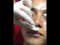 Đốt nốt ruồi mụn thịt tàn nhang nám chân