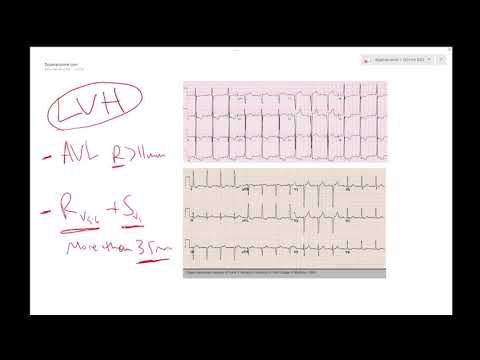 LVH on ECG (Left ventricular hypertrophy) - Learn ECG! - Dr Jamal USMLE