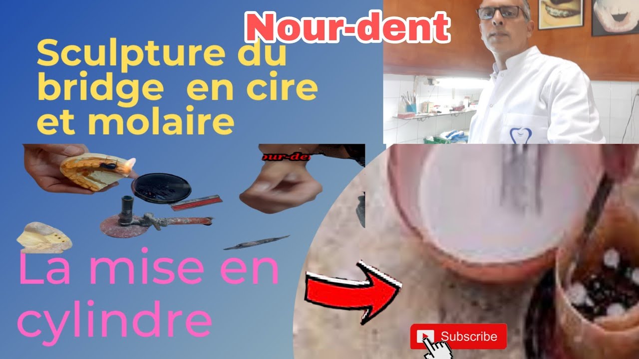 sculpture du bridge en cire et molaire dentaire. et la mise en cylindre. 