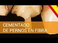 ENDODONCIA - Cementado de Pernos en Fibra