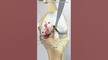 Partial knee replacement surgery #drone #doctor #shockwavetherapy