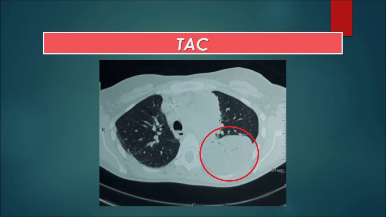 VATS por Empiema Pleural camera iphone 8 plus apk