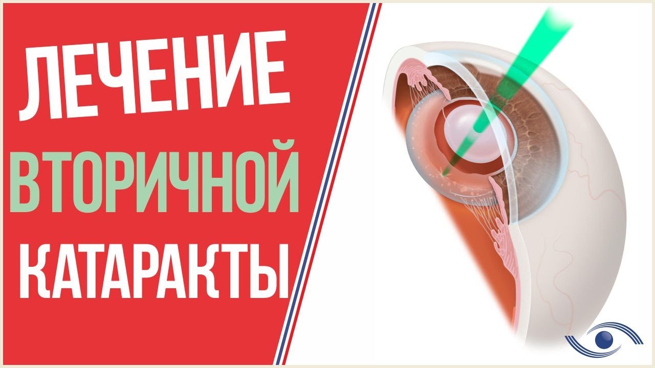 Лазерная Дисцизия Вторичной Катаракты Цена