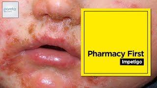 Pharmacy First | Impetigo | Pharmacists