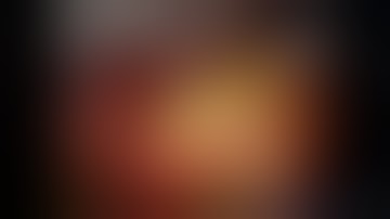 Robotic Apical and posterior segmentectomy in a patient with an aberrant Superior pulmonary vein