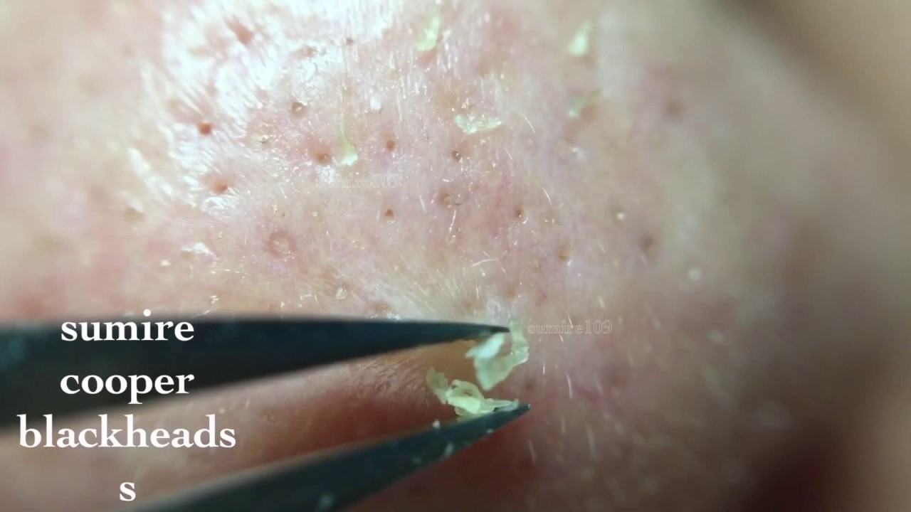 鼻角栓109nose Blackheads Tweezers Only Youtube