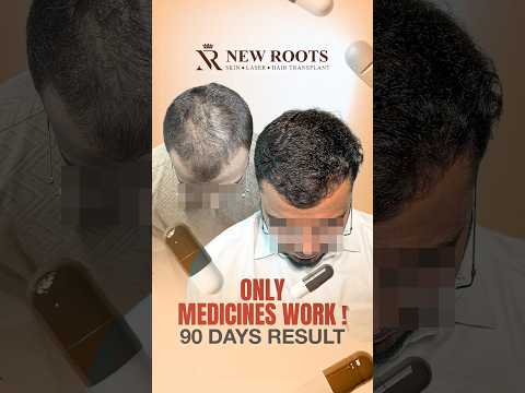 3 Months Hair Transplant Results | Aurangabad | Marathi #hairtransplant #shorts