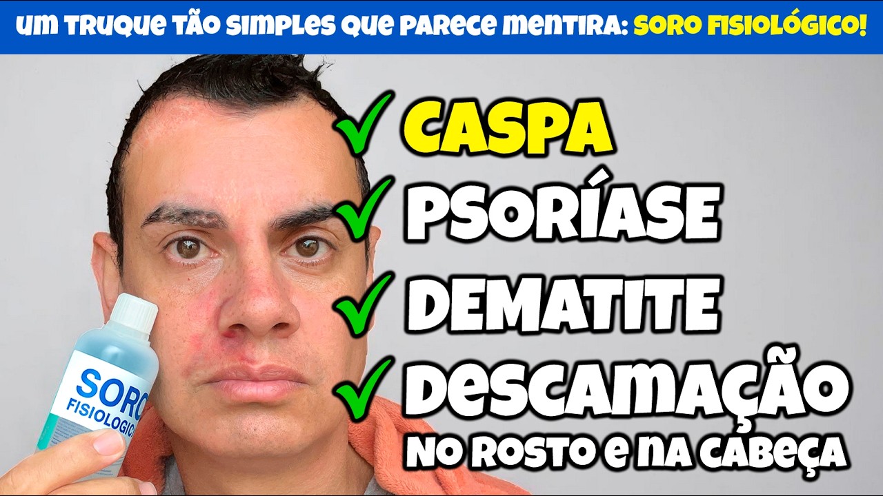 SÓ ISSO acaba com a CASPA, PSORÍASE e DERMATITE! Eu fiz e FUNCIONA!