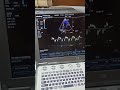 Tissue Doppler image TDI Echocardiography