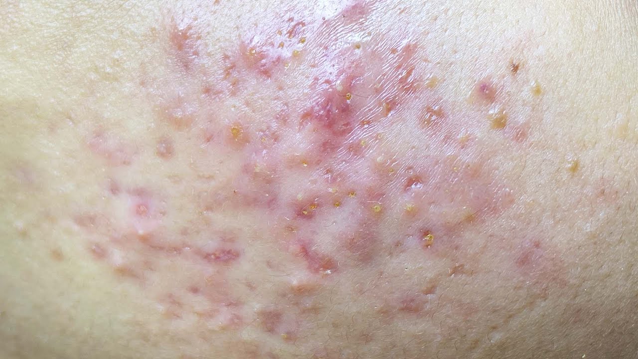 Blackheads Under The Skin, Pitted Scars | Mụn Đầu Đen Nhân Sâu Dưới Da Gây Sẹo Rỗ -  SacDepSpa#190