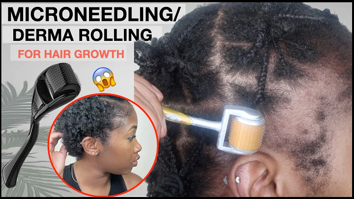 MICRO-NEEDLING/DERMA ROLLING FOR EDGE GROWTH  | Two Month Update | TRACTION ALOPECIA 🚨 NO MINOXIDIL - DayDayNews